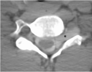 Left Brachial Plexus Tumor