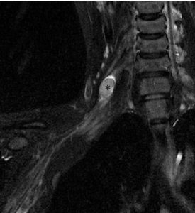 Right Brachial Plexus Tumor